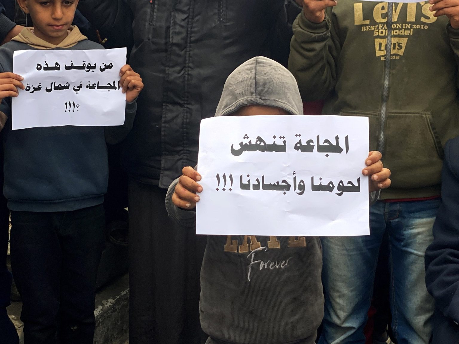 أطفال غزة.. آثار صحية كارثية للمجاعة وسوء التغذية