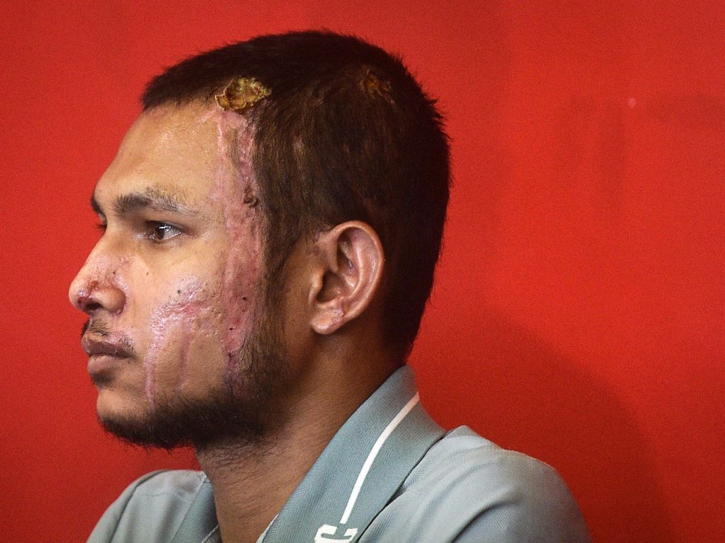 أول ظهور علني لفيصل حليم لاعب ماليزي تعرض لهجوم كيميائي