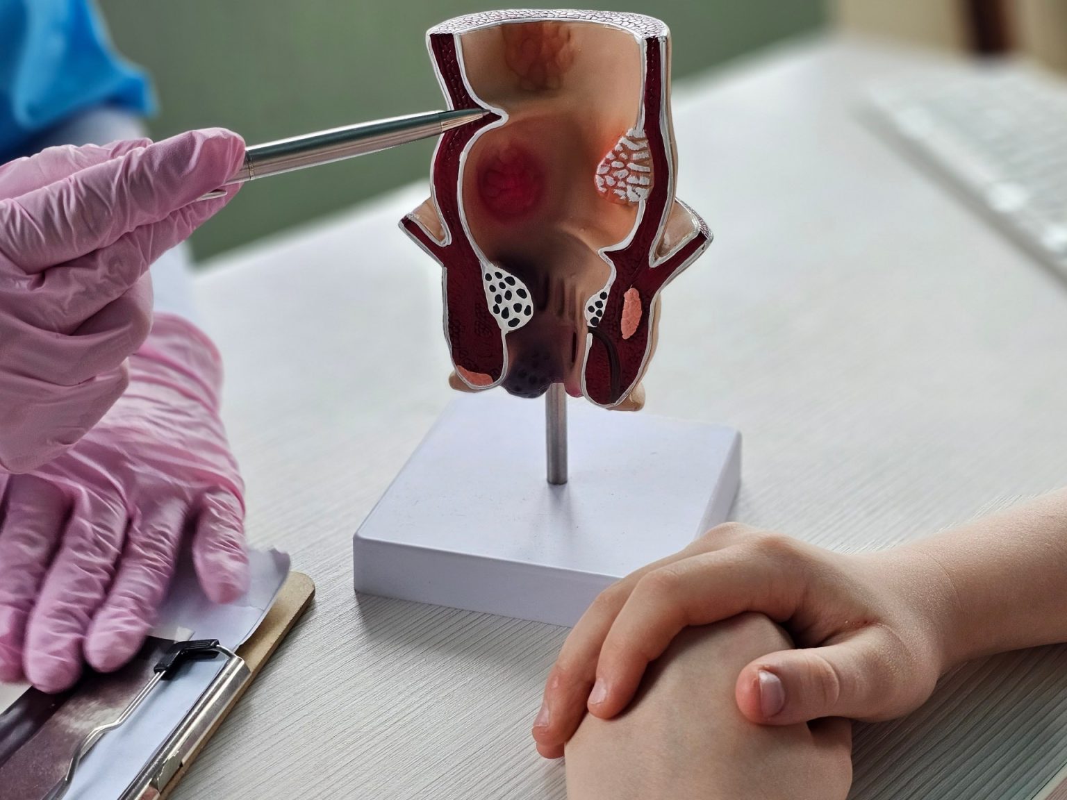 البواسير.. متى يصبح التدخل الجراحي ضرورة؟